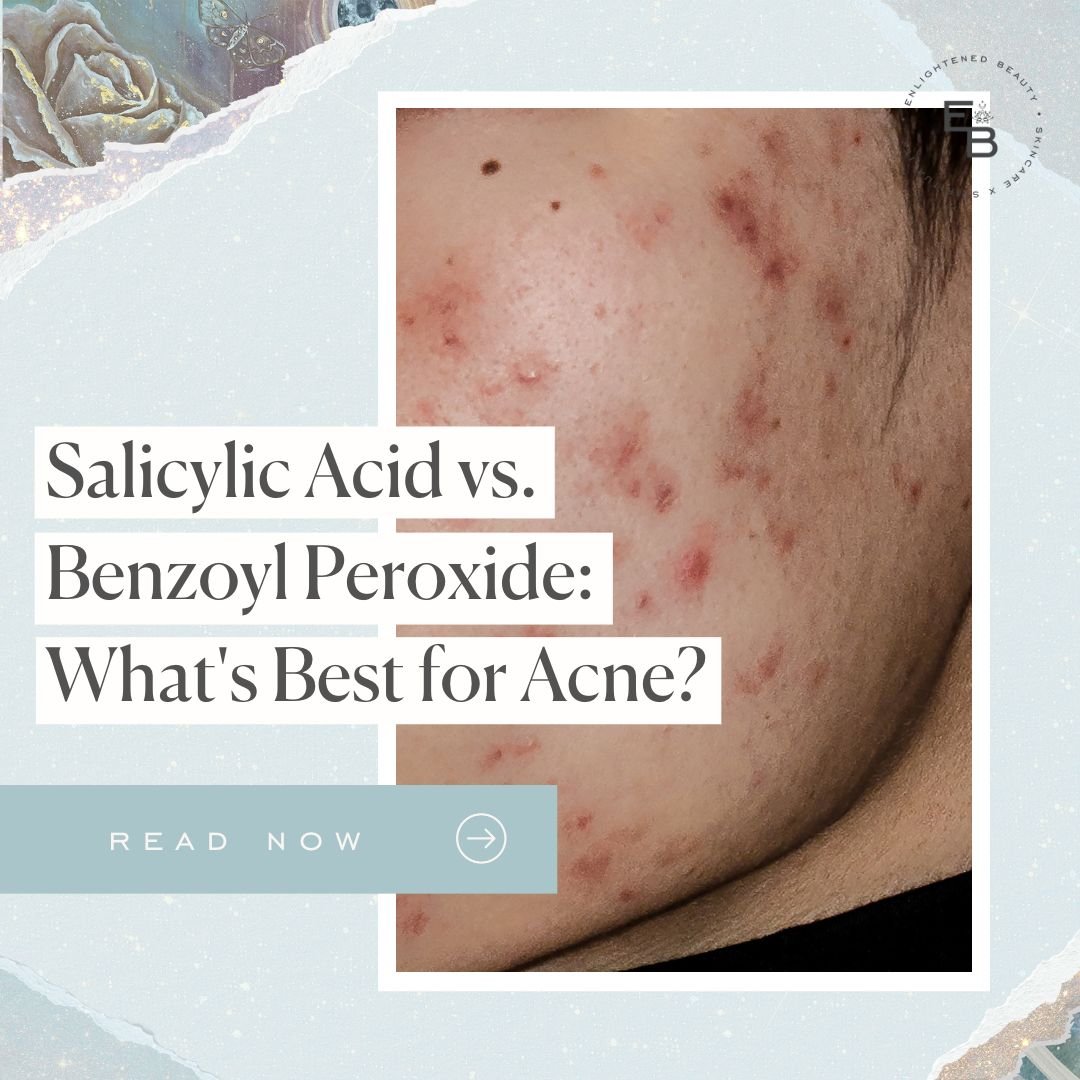 Benzoyl Peroxide vs Salicylic Acid: Which is Better for Acne?