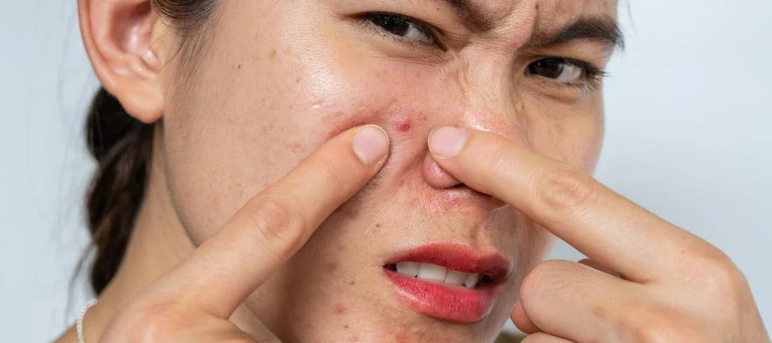 Battling Acne and; Skin Irritation During Monsoon: Skincare Switch Tips You Need