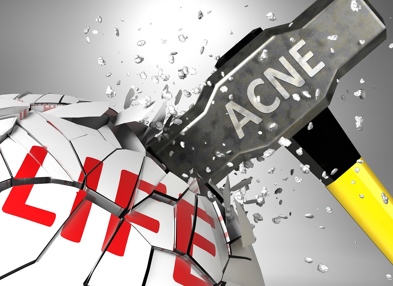 How Long Does Benzoyl Peroxide Take to Clear Acne?