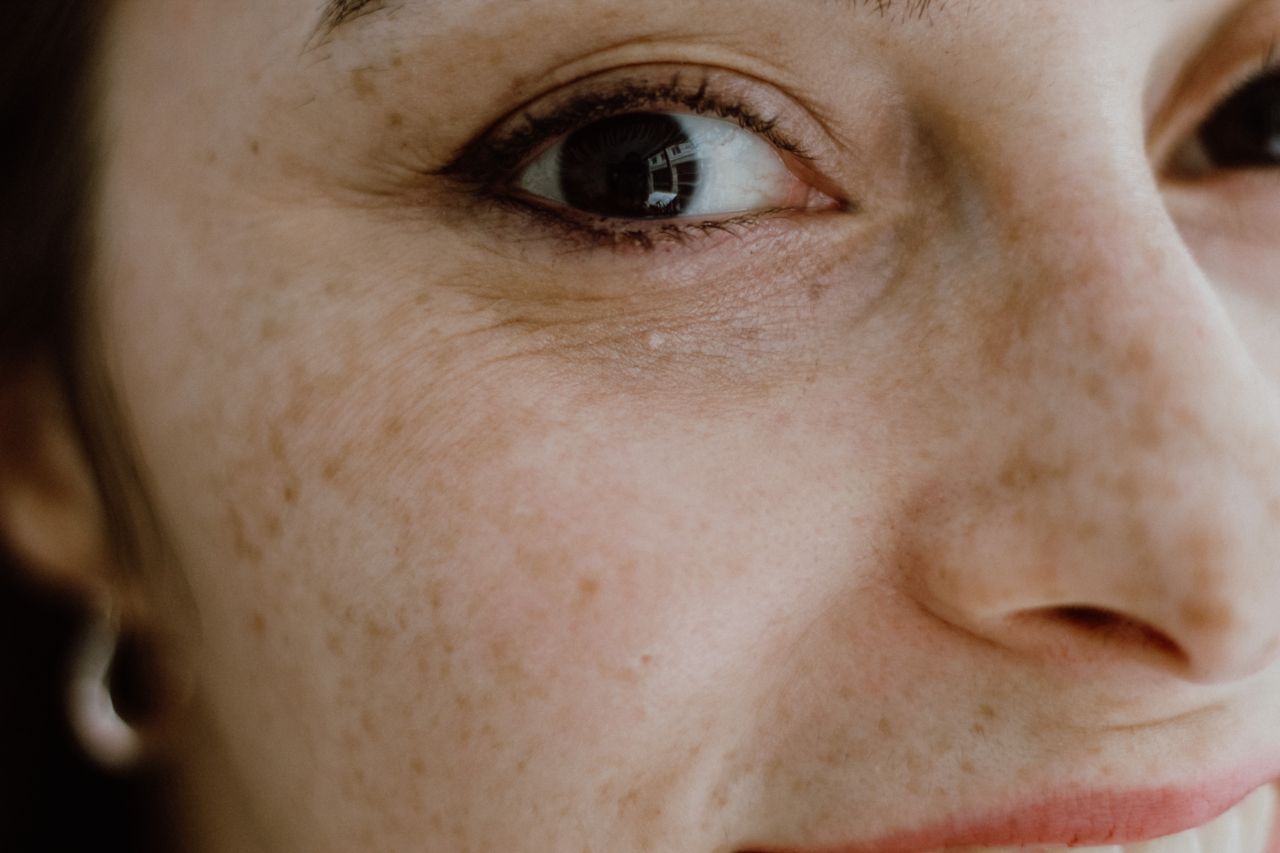 Best Products for Acne Marks and Post-Breakout Dark Spots
