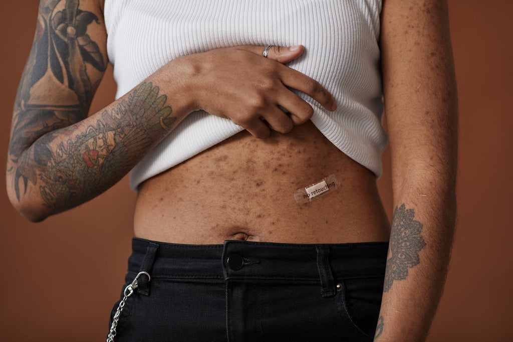 Benzoyl Peroxide for Pimples: Does It Really Work? Here's Everything You Need to Know