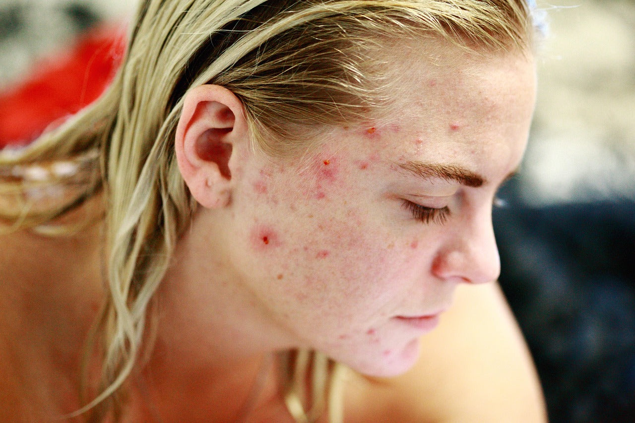 Acne vs Fungal Acne: How to Tell the Difference (and What to Do About It)