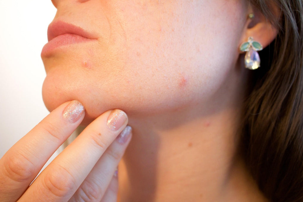 Best Products for Hormonal Acne in Adults: What Really Works in 2025?