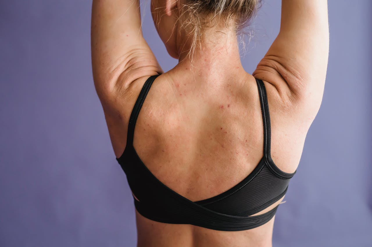 Back Acne in Summer India — Why It Gets Worse & How to Clear It